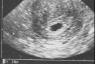 超音波の赤ちゃんの写真