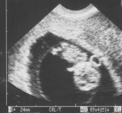 超音波の胎児の写真